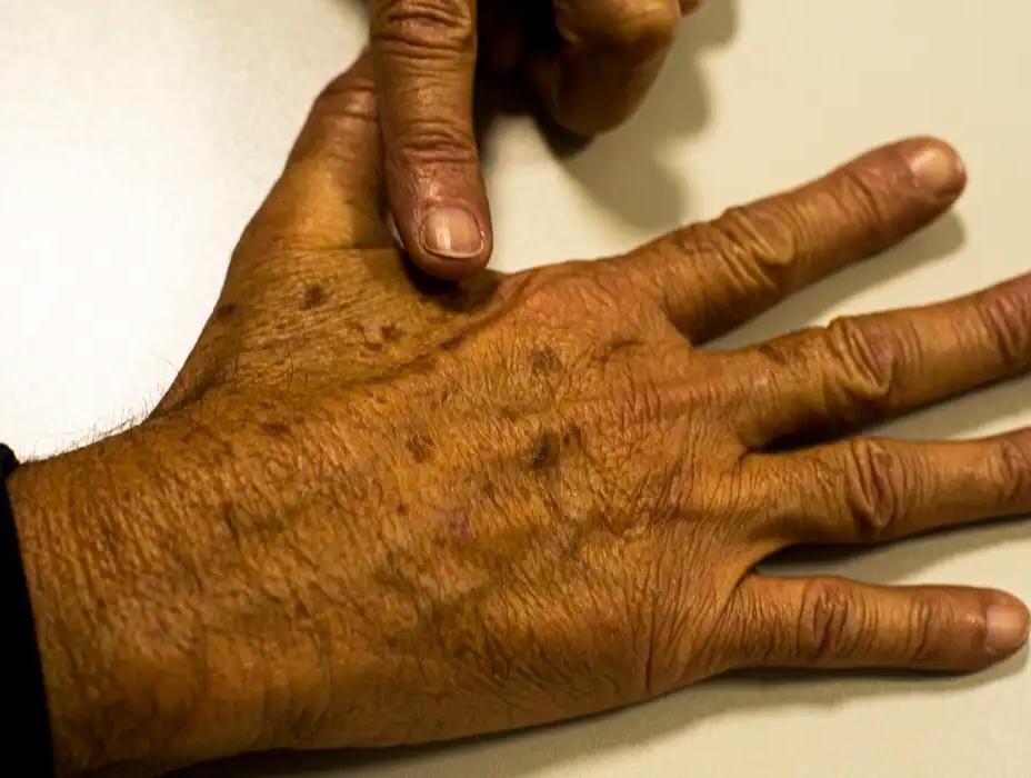 Câncer de pele: com a chegada do verão, prevenção é fundamental para evitar a doença