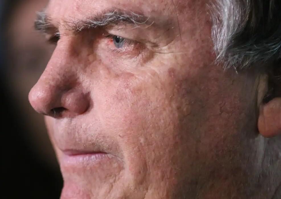 Com crise persistente de soluços, Bolsonaro faz nova cirurgia