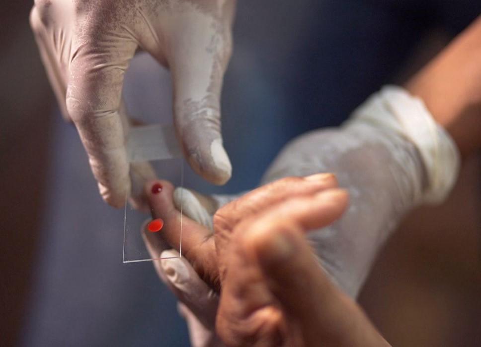 SUS começa a usar novo tratamento contra a malária em crianças